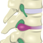 Herniated lumbar spine disc