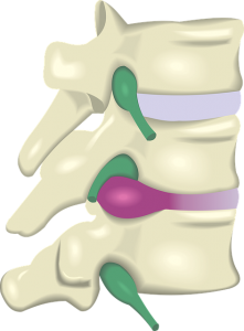 Herniated lumbar spine disk
