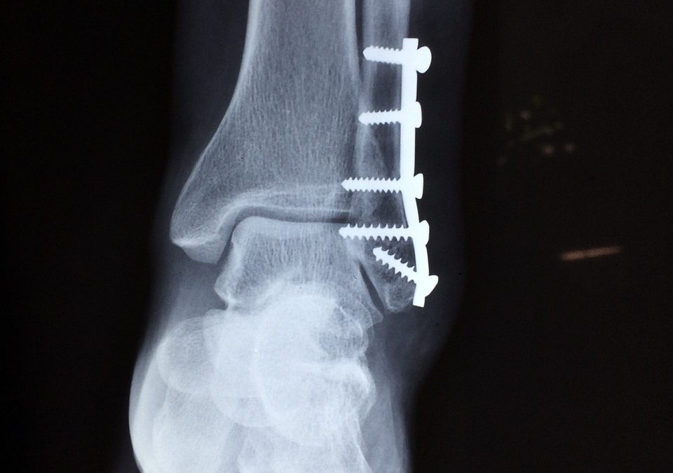 Reduce Your Risk Of Chronic Ankle Pain By Up To 80%